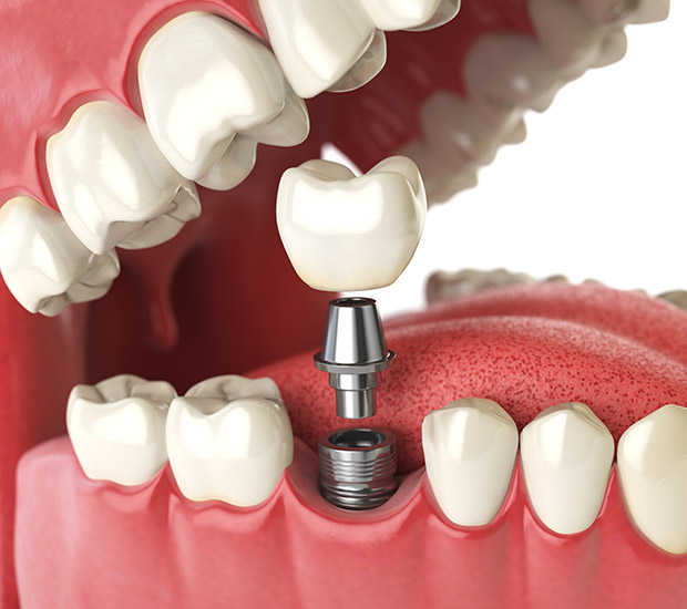 Tucson Will I Need a Bone Graft for Dental Implants