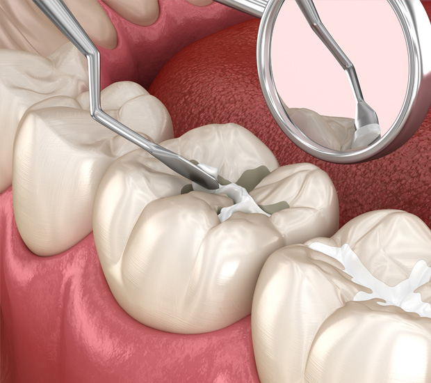 Tucson Dental Sealants